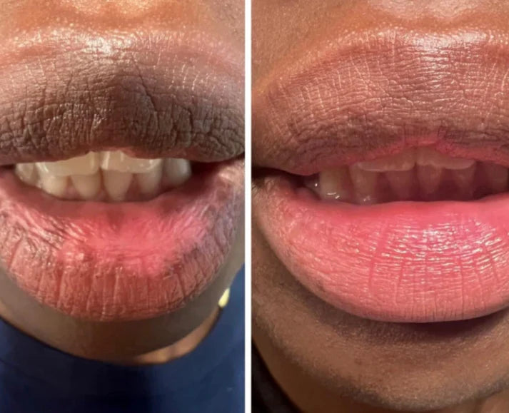 Rema™ Dark Lip Peel-Off Mask
